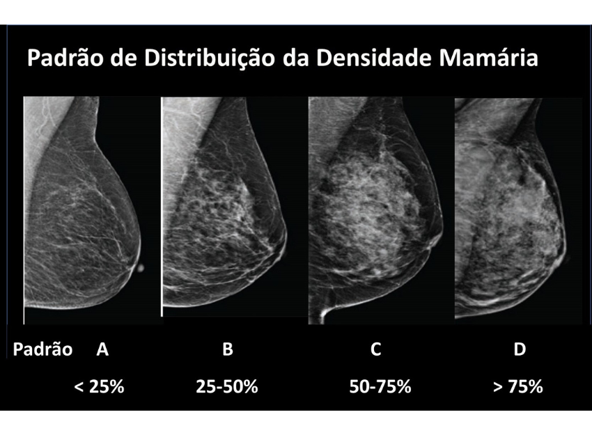 Esquema da densidade mamária de A a D