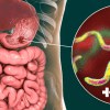 H.pylori: sintomas, causas e diagnóstico 