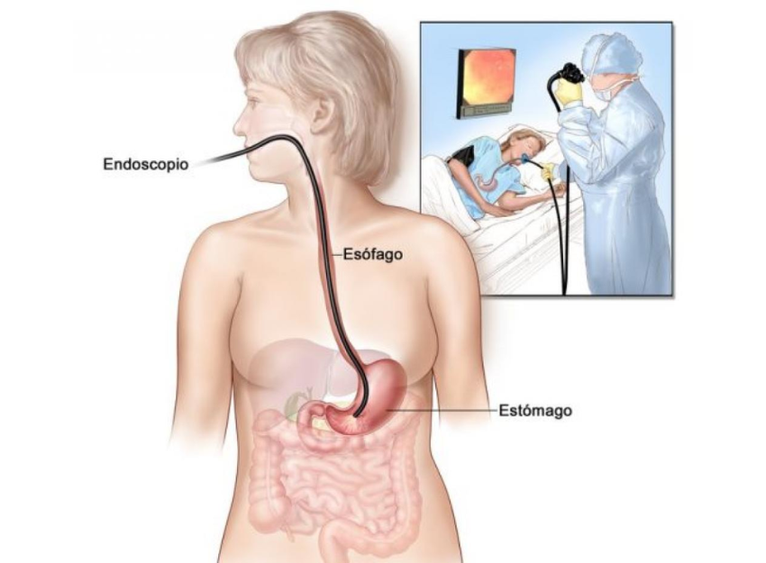 Endoscopia alta para deteção H.pylori Farmácias Correia Rosa Caldas da Rainha